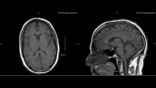 Unremarkable NonContrast Brain MRI Sagittal T1Example 1 [upl. by Frodeen527]