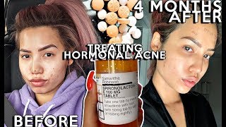 Treating my Hormonal Cystic Acne with Spirolactone  4 MONTHS Before amp Afters  ProsCons [upl. by Loralyn]