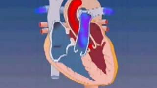 Atrial Septal Defect [upl. by Nhguavahs]