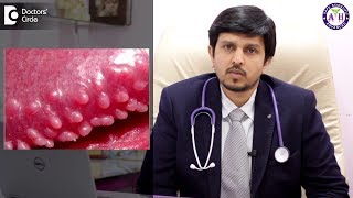 How to treat Pearly Penile Papules  Dr Sanjay Panicker [upl. by Jewett]