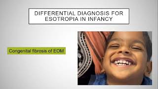 Esotropia Enigma Understanding and Managing Childhood Strabismus [upl. by Aric]