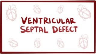 Ventricular septal defect VSD  repair causes symptoms amp pathology [upl. by Iraj]