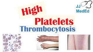 What Causes High Platelets Thrombocytosis  Approach to Causes Symptoms Treatment [upl. by Oivat]