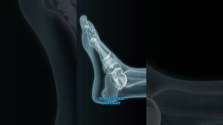 3Dprinted ankle implants 3D Animation [upl. by Novi]