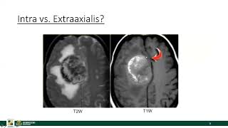 Az intracranialis daganatok általános jellemzői [upl. by Leihcim]