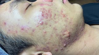 ACNE TREATMENT VU QUYNH MI Blackheads On Boy Face 2024 [upl. by Airbmak]