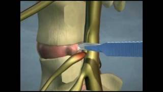 Lumbar Disc Herniations [upl. by Atimed289]