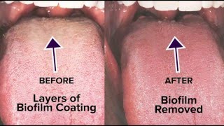 Tongue Rejuvenation The ANSWER to Fixing Chronic Bad Breath amp Halitosis [upl. by Alaj]