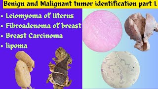 Leiomyoma of Uterus Fibroadenoma of breast Breast Carcinoma Lipoma identificationPatho exam OSPE [upl. by Eked684]