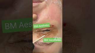 LIVE Neck Lift Fibroblast Plasma Skin Tightening [upl. by Reseda]