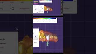 ExocadFirst premolar implant design digitaldentistrywzsamee7 takedigitalstep dentaltechnology [upl. by Laerol]