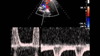 SUBCLAVIAN ARTERY STEAL [upl. by Annahc]