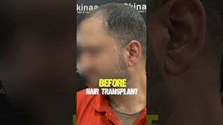 Hair Transplant Journey of a Patient Before amp After Results at Skinaa Clinic viral [upl. by Drofyar]