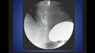 Case Discussion  Esophageal Varices [upl. by Eiffe]