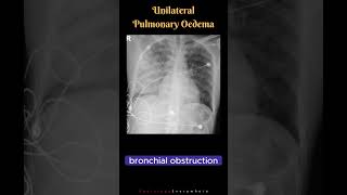 Unilateral Pulmonary Oedema Differential Diagnosis Radiology tutorials shorts [upl. by Tamiko]