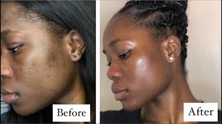 Clear Skin In 3 Months On Low Dose Accutane  What You Should Know  Helen Suah  acne [upl. by Aznofla]