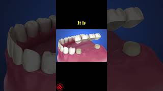 Tooth supported fixed bridge instalation process health wellness shorts [upl. by Nnaaihtnyc]