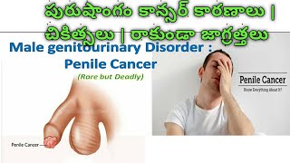 penile cancer symptoms and treatment  పురుషాంగ క్యాన్సర్ లక్షణాలు మరియు దాని చికిత్స [upl. by Grethel]