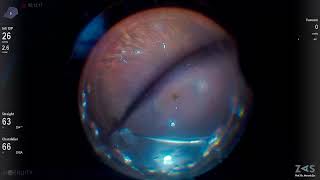 Autologous Retinal Transplant in Macular Hole Surgery [upl. by Ihc]