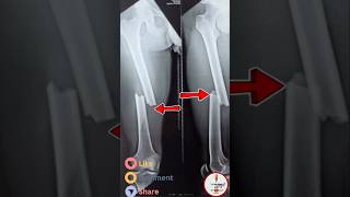 Shaft femur fracture treatment lldr Irfan Siddiquillorthodoctor orthohospital [upl. by Pennington412]