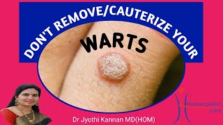 Dont Remove or Cauterize your warts [upl. by Kenzi798]