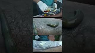 Psoriasis Relief with Leech Therapy [upl. by Anemolihp]