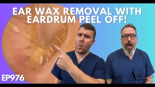 EAR WAX REMOVAL WITH EARDRUM PEEL OFF  EP976 [upl. by Gwyneth25]