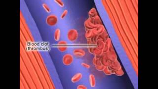 Formation of Deep Vein Thrombosis [upl. by Adok]