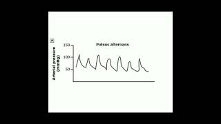 🍁 PULSUS ALTERNANS 🍁 [upl. by Htennaj]