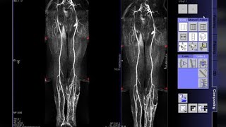 Periferik Anjio MR Nasıl Çekilir Abdominal Anjio Nasıl Çekilir Kanal Radyoloji MR Çekim Teknikleri [upl. by Aurie]
