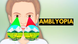 Amblyopia Causes Signs and Symptoms Diagnosis and Treatment [upl. by Lichtenfeld]