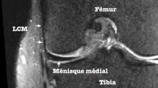 Plan Ligamentaire Médial interne du Genou [upl. by Seavir]