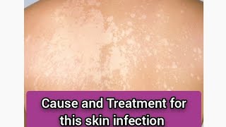 1 Cure to pigmented discoloration on your skin health  goviral [upl. by Sothena]