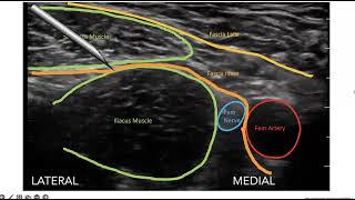 Erector Spinae Plane ESP Block [upl. by Tiffie]