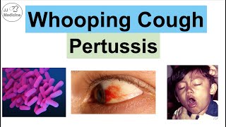 Whooping Cough Pertussis  Transmission Pathophysiology Symptoms Diagnosis Treatment [upl. by Nekial]