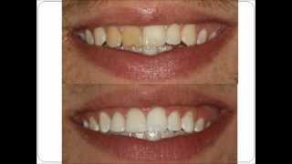 Spanish  Invisalign Teeth Whitening Dental Implants Bronx New York Dentistry Video  Musicwmv [upl. by Gifferd]