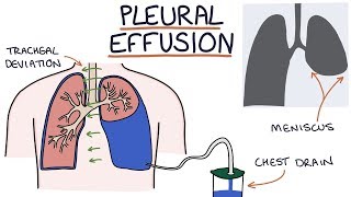 Understanding Pleural Effusions [upl. by Latoya]