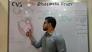 CVS module  Rheumatic fever part 1 [upl. by Kerek]