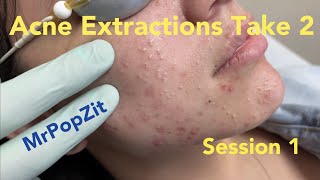 Acne extractions take 2 session 1 Blackheads whiteheads Ears 20 minutes of just the pop ASMR [upl. by Jonny745]