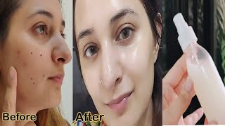 I Used Rice Water For 3 Months and the result is Amazing All Acne Dark Spots Dull Skin Gone [upl. by Yeorgi]