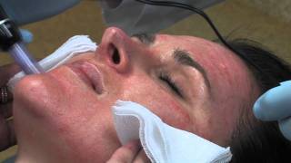 Dr Mark B Taylor Review of Dermapen Micro Needling  Gateway Aesthetics [upl. by Rubliw]