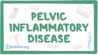 Pelvic inflammatory disease  causes symptoms diagnosis treatment pathology [upl. by Leuqcar]