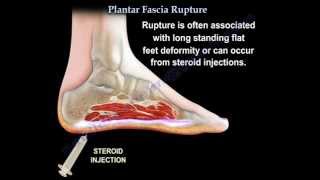 Plantar Fascia Rupture  Everything You Need To Know  Dr Nabil Ebraheim [upl. by Orji]