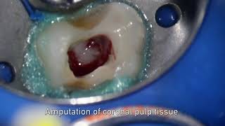 MTA pulpotomy – Video abstract ID 134315 [upl. by Arrim]