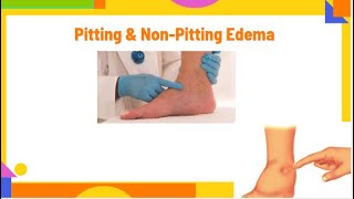 pitting amp nonpitting edema  edema types and causes  edema  PhysiotherapyKnowledge [upl. by Winson]