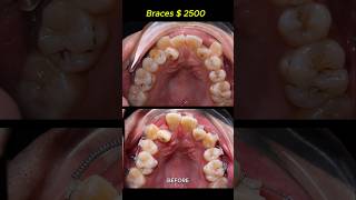 Cost  2500 for this case Braces crooked teeth braces orthodontist dentist [upl. by Edsel106]