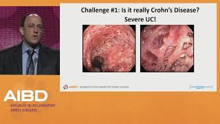 Challenges in the treatment of severe Crohns disease [upl. by Nevaed]