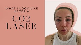 My CO2 Laser Experience PostTreatment Transformation and Recovery Tips by an Expert Dermatologist [upl. by Heng60]