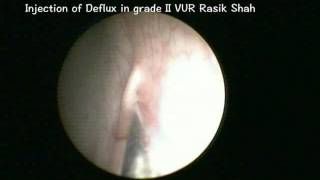 Sting for VUR by Dr Rasik Shah [upl. by Ellard]