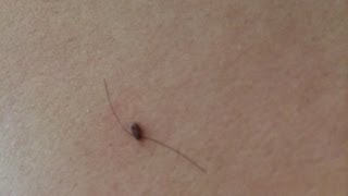 How To Get Rid of Skin Tags Naturally [upl. by Ahsinaw843]